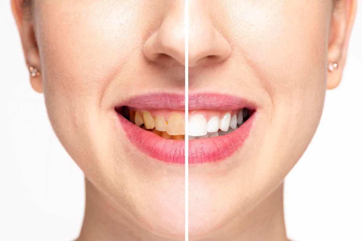 Teeth Whitening Chandler