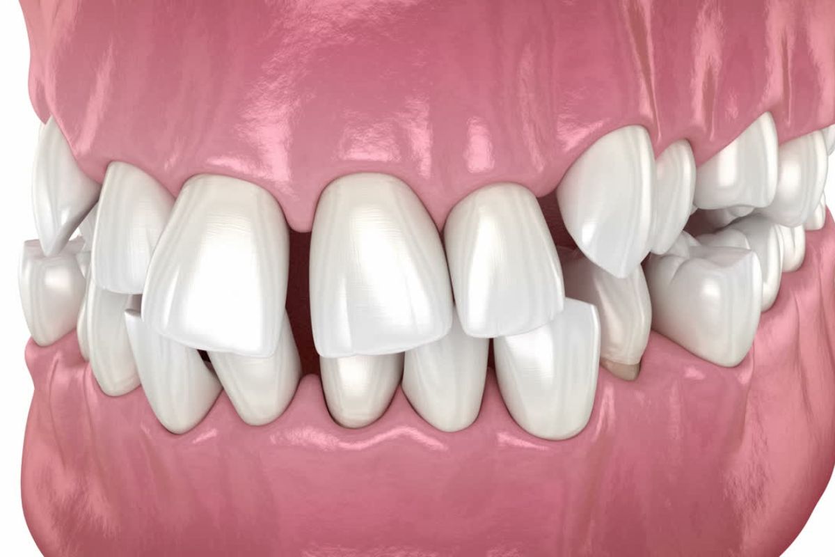 Fix Gapped Teeth with Cosmetic dentistry Options Will Help