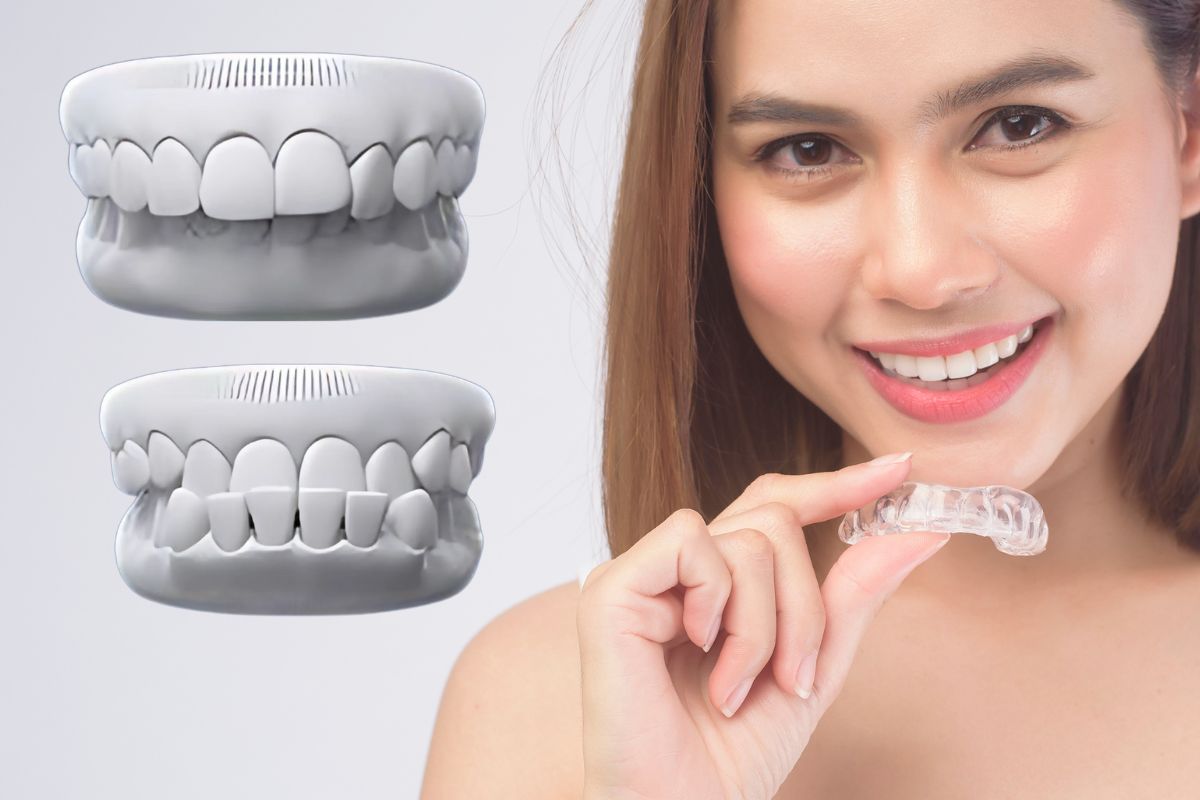 Fixing Overbites And Underbites