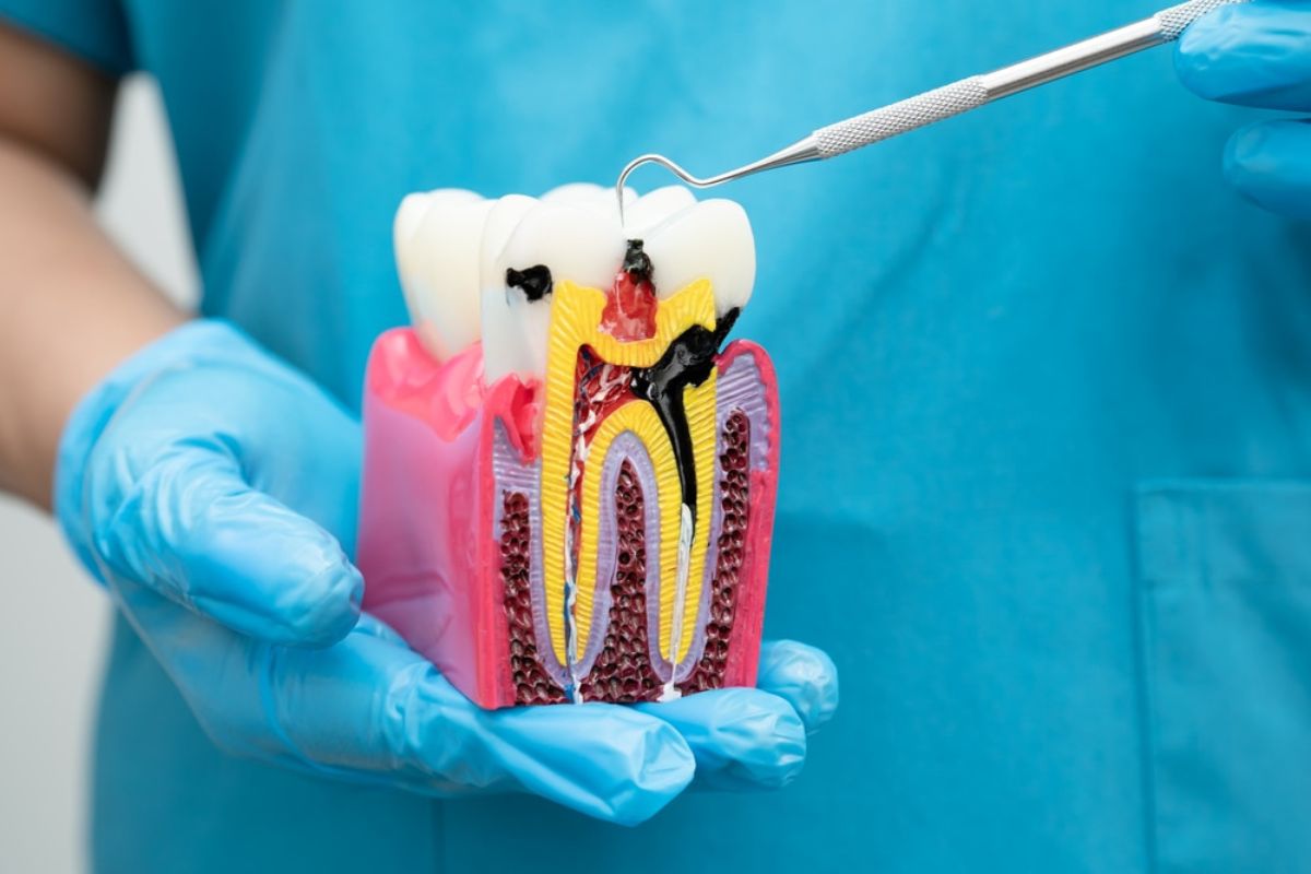 Root Canal After A Dental Filling
