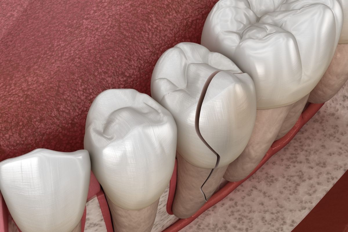 Fix A Crooked Tooth With Cosmetic Bonding