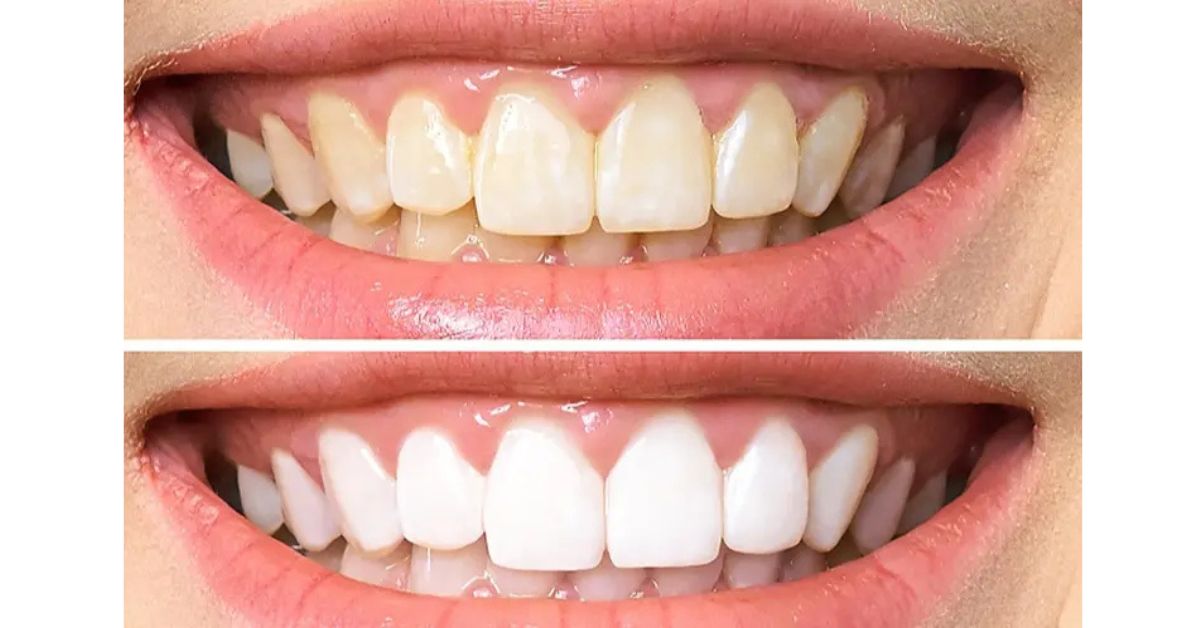 Smile After Teeth Whitening Treatment