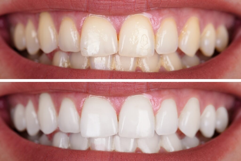 Dentist’s Guide: How Often Should You Whiten Your Teeth