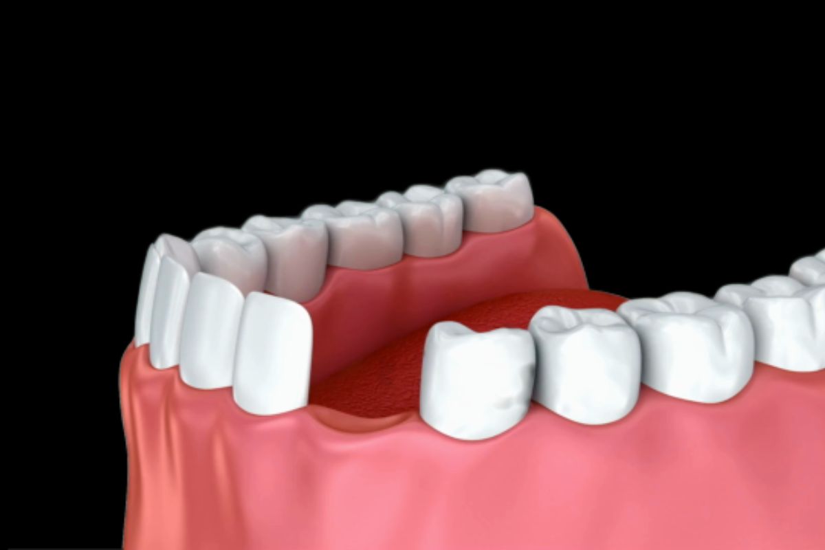 Lost A Tooth? Temporary Replacements & What's Next