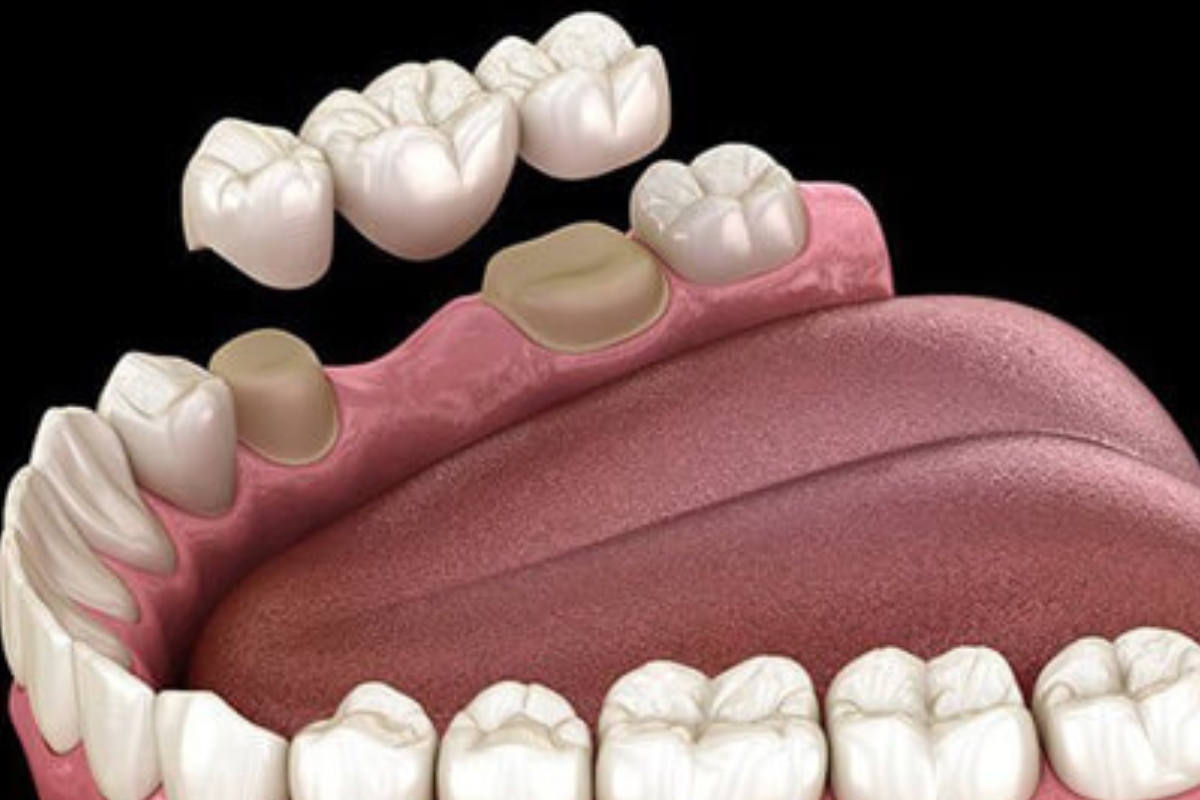 Dentists Recommend Bridges for Replacing Missing Teeth