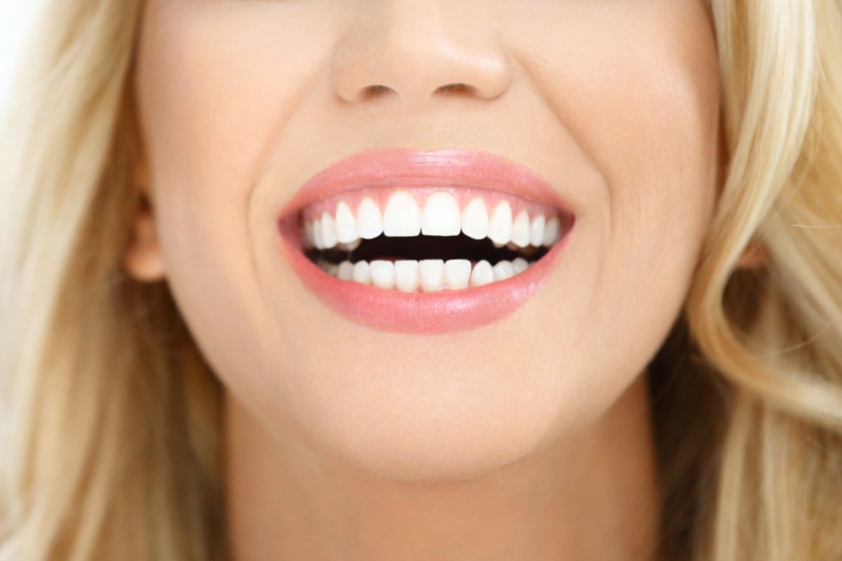 top five dental flaws that cosmetic bonding can fix