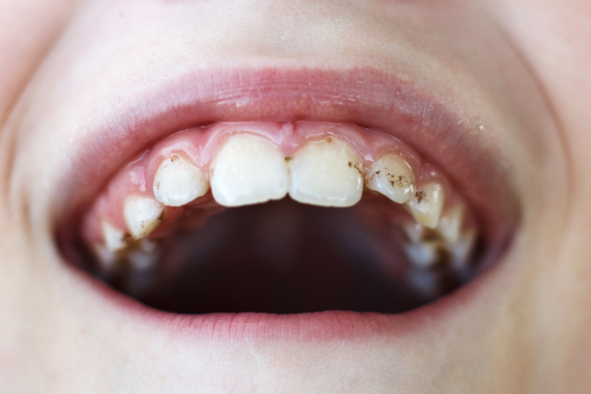 Get Rid of White Spot Lesions on Teeth