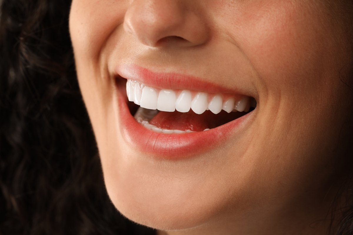 Benefits of Choosing Veneers at Provinces Dental