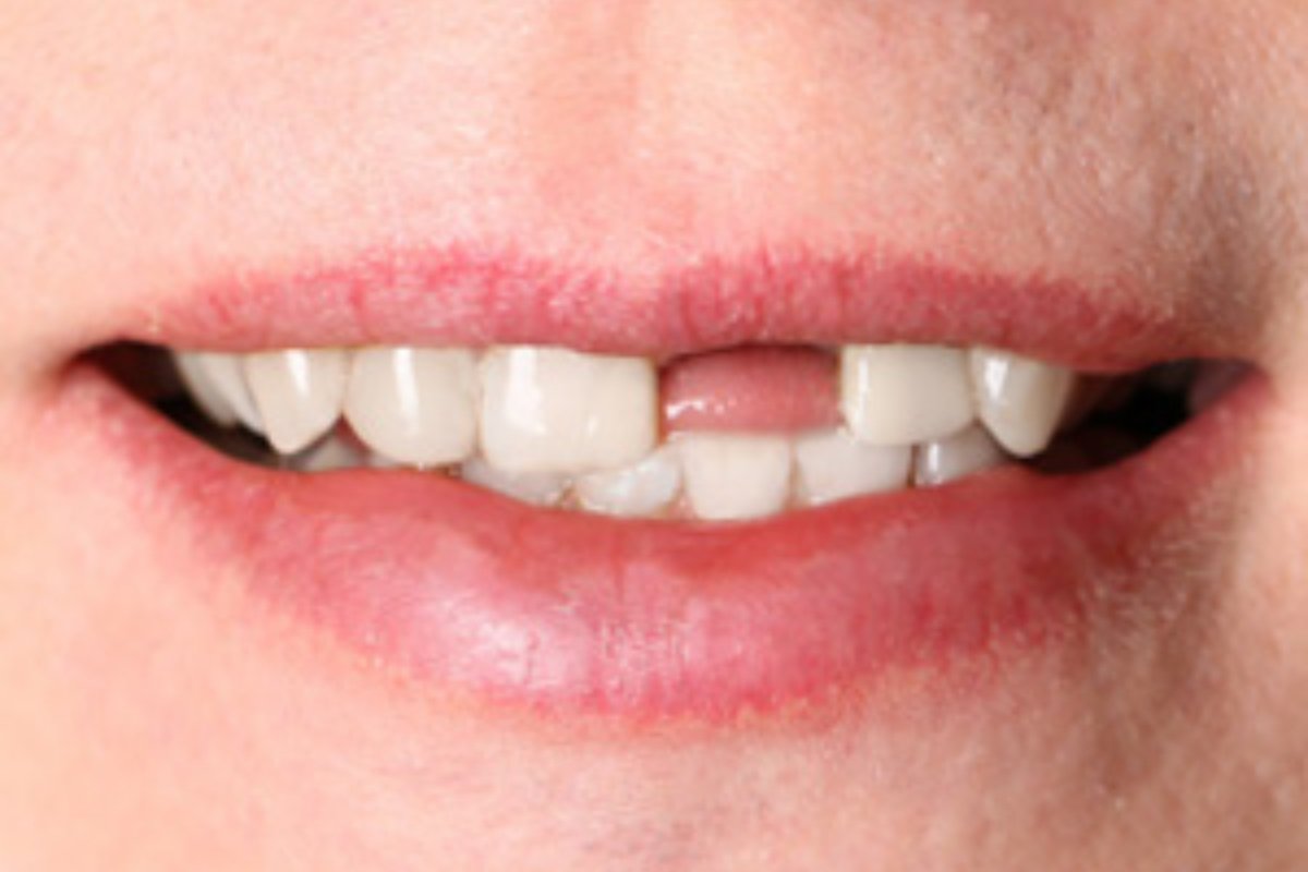 Replace Missing Tooth Roots