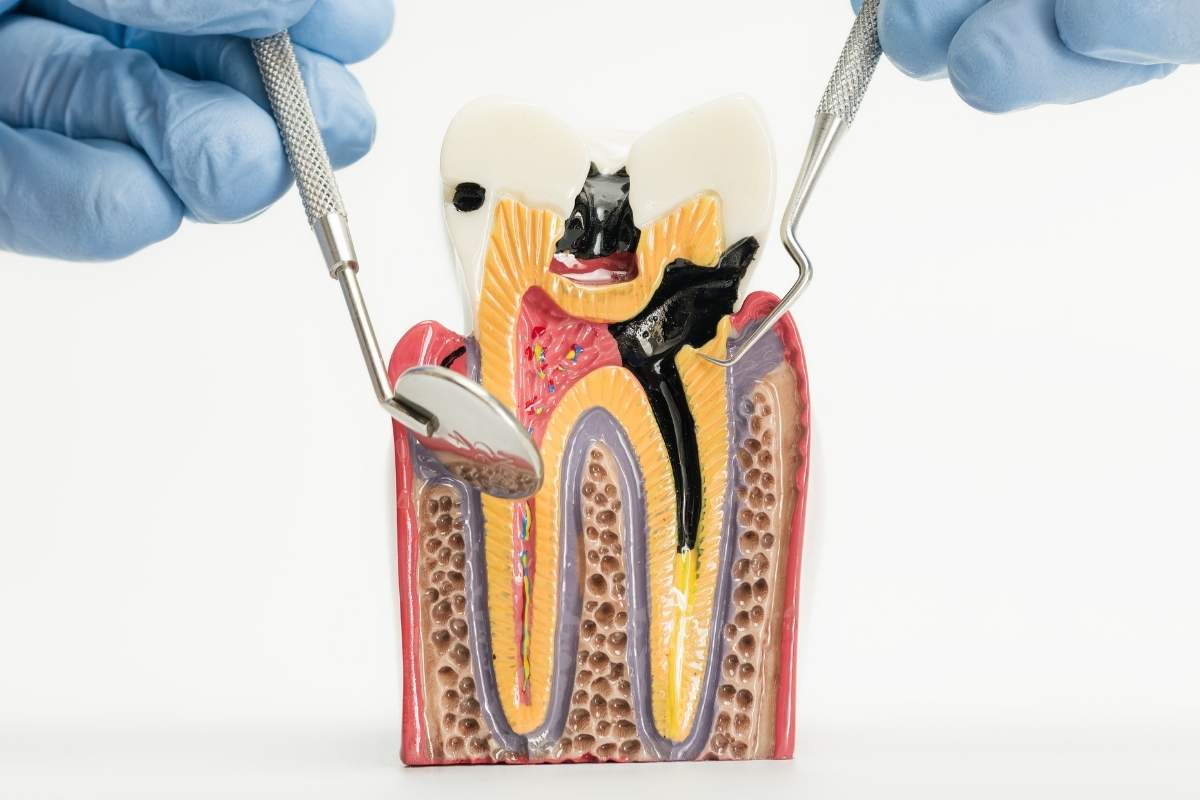 Understanding Dental Pulp Causes, Symptoms & Treatments
