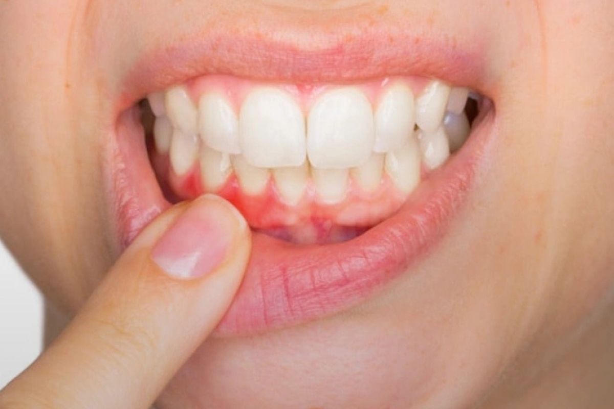 Cause Gum Bleeding During Flossing