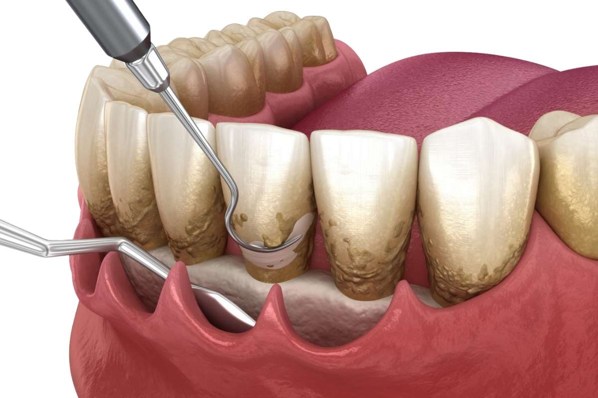 Diagram showing plaque formation between teeth and along the gum line