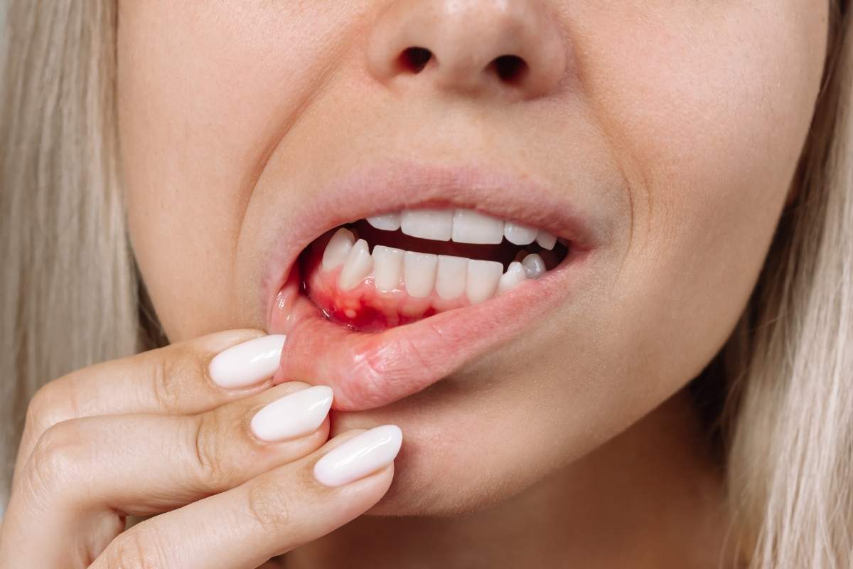 How To Stop Bleeding Gums