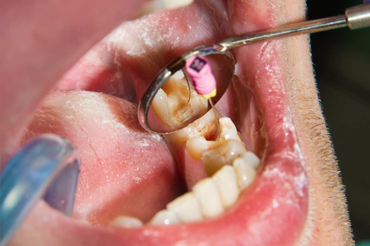 Root Canal Procedure & Recovery:
