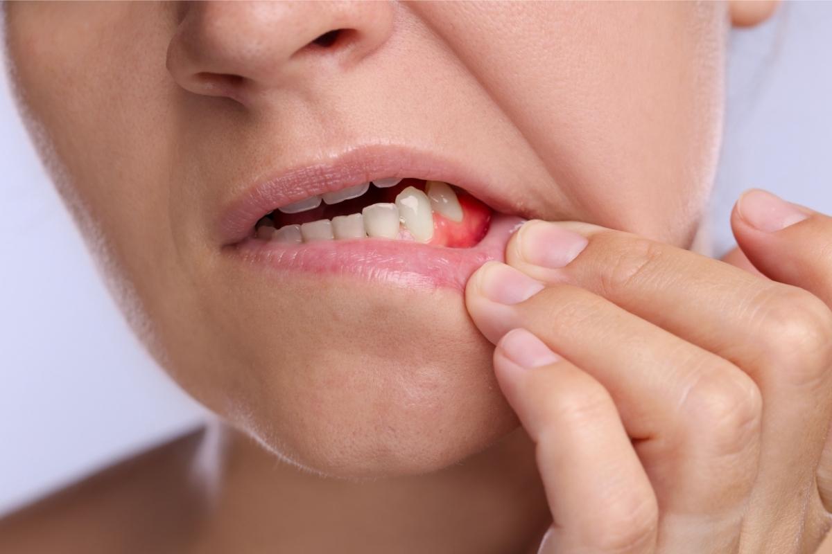 Lump on Your Gum a Dental Emergency