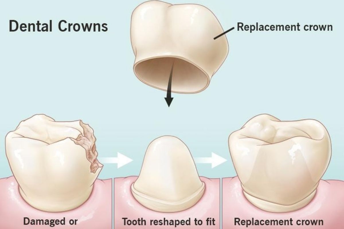 dental crown fell off what to do