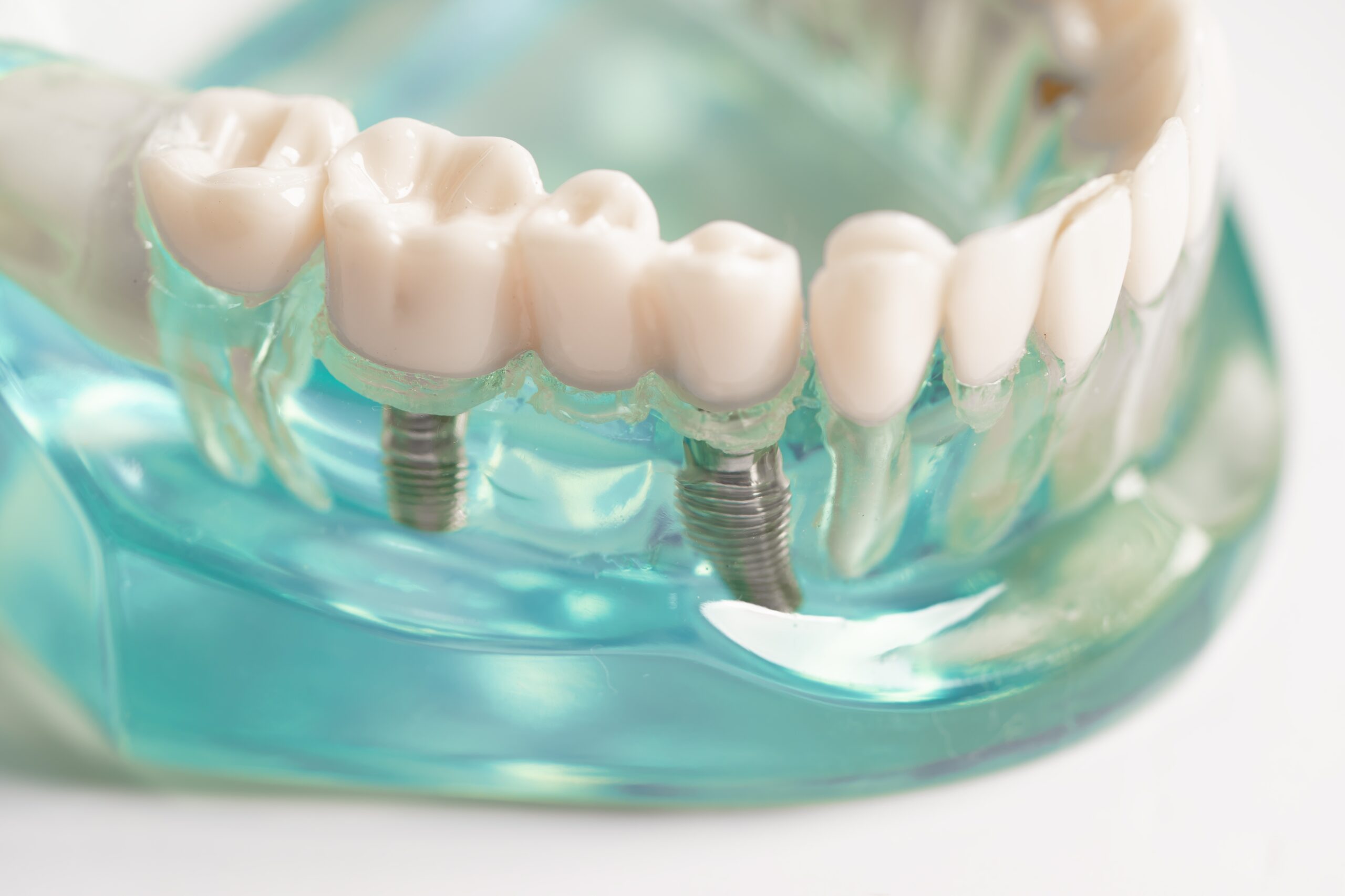 dental-implant-artificial-tooth-roots-into-jaw-chandler-AZ